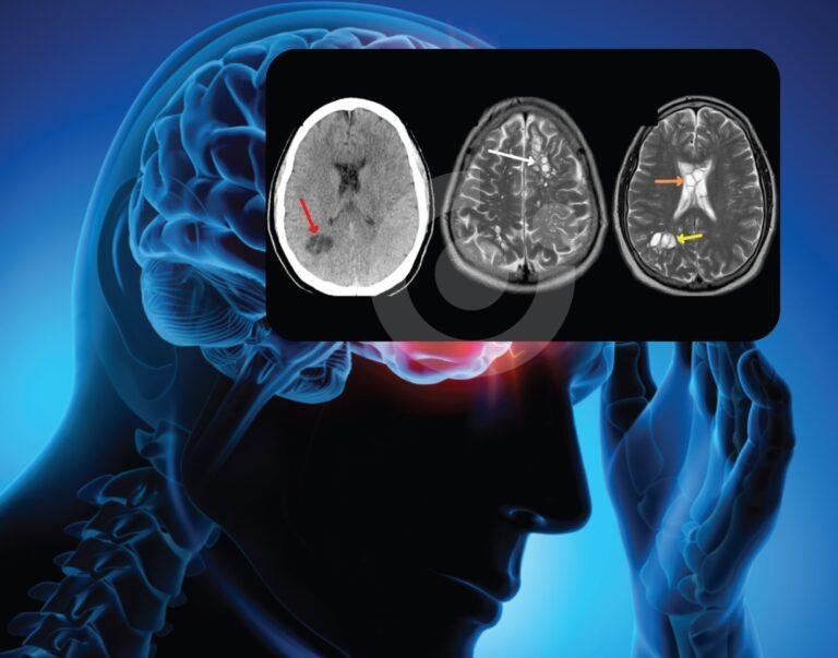 Hombre descubrió que tenia larvas en el cerebro por comer carne de cerdo